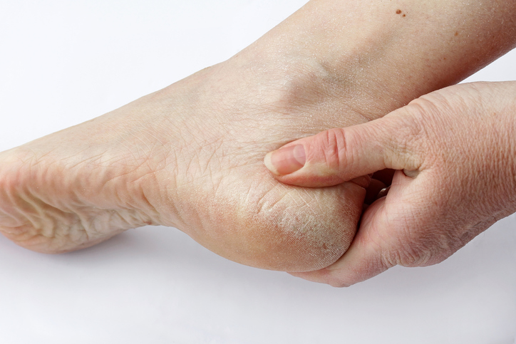 Trockene Haut am Fuß, an der Ferse oder zwischen den Zehen bei pilzbedingter Dermatitis