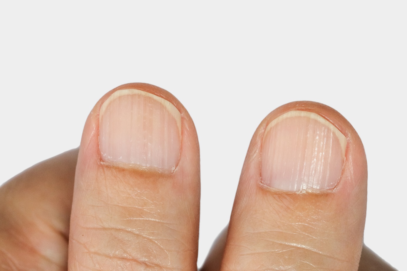 Vertikale Rillen auf den Nägeln - Finger, Nagel und Rillen