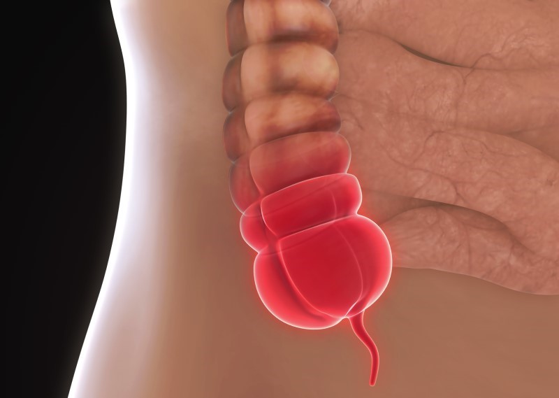 Entzündete Appendix veriformis (Wurmfortsatz) - anatomische Darstellung