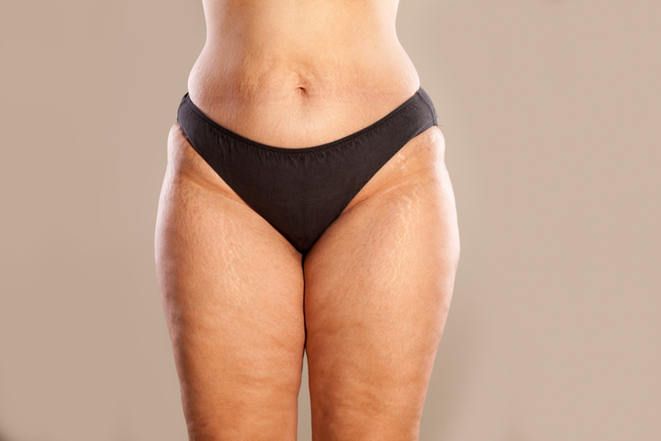 Cellulite, Oberschenkel, Frau