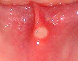 kleine Aphthen auf der Schleimhaut der Mundhöhle