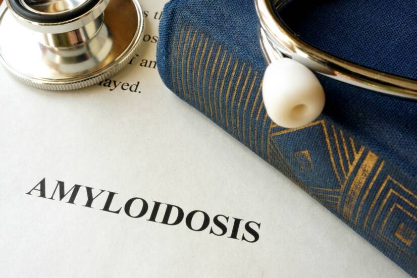 Amyloidose: Was ist das und warum entsteht sie, welche Symptome hat sie?