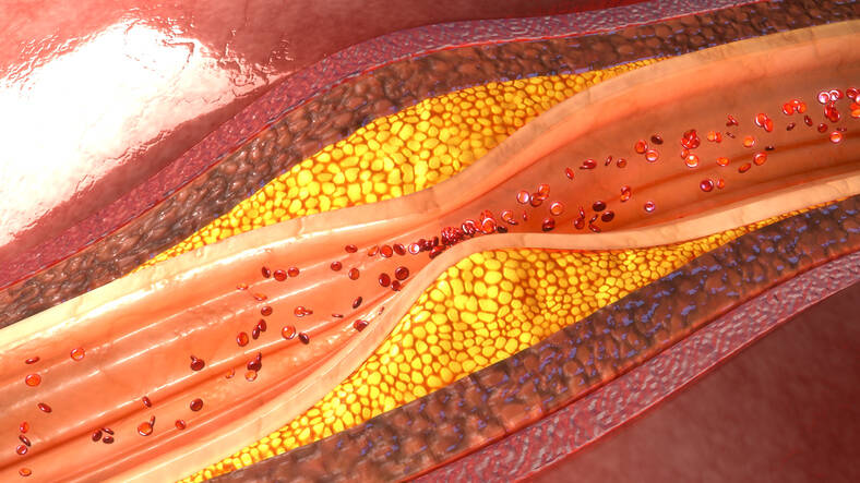 Atherosklerose: Kennen Sie die Symptome oder Ursachen, Risiken, Prävention?
