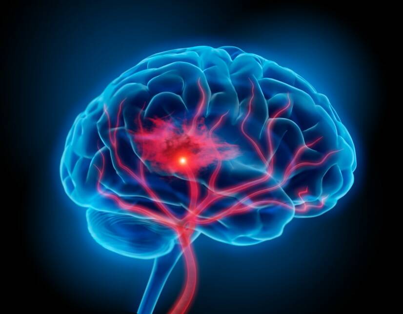 Blutungen im Gehirn: Warum treten sie auf und was sind ihre Symptome?