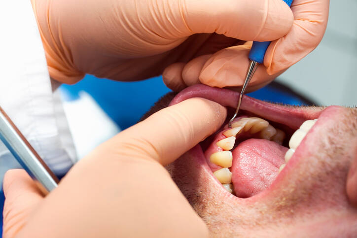 Parodontitis: Warum tritt sie auf? + Wie wird man eine Zahnlockerung los und die Zähne stärken?