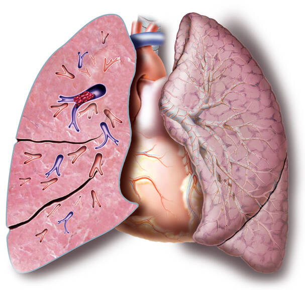 Lungenembolie: Warum entsteht sie, wie manifestiert sie sich? Wie wird sie erkannt und behandelt?