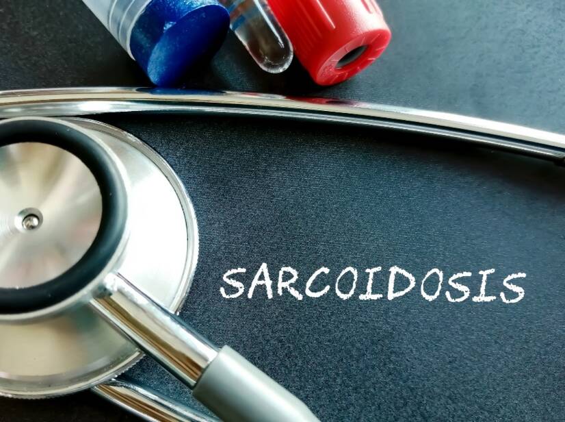 Sarkoidose: Was ist Sarkoidose und was sind ihre Ursachen/Symptome? Pulmonale und extrapulmonale Formen