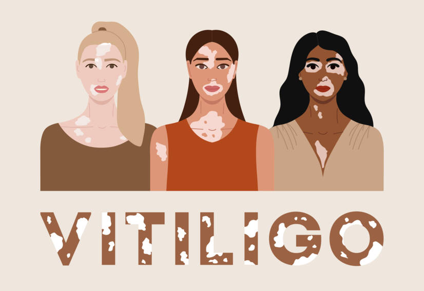 Vitiligo: Was ist Vitiligo und was sind die Ursachen und Symptome? Wann beginnt sie?