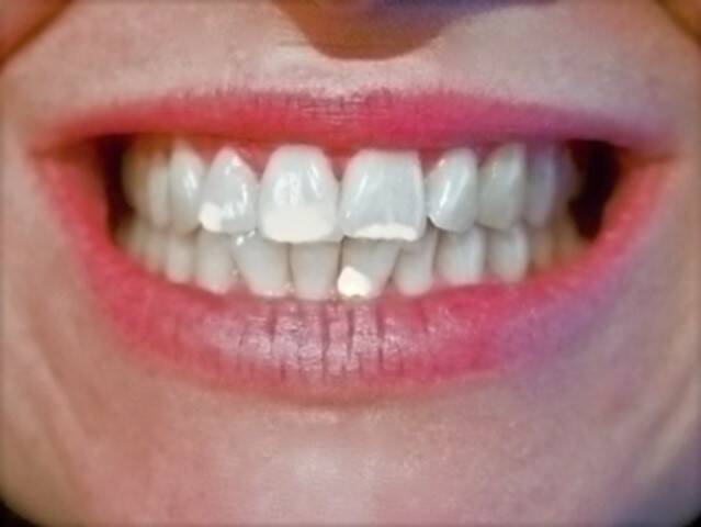 Weiße Flecken auf den Zähnen und ihre Ursachen - wie wird man diese Flecken los?