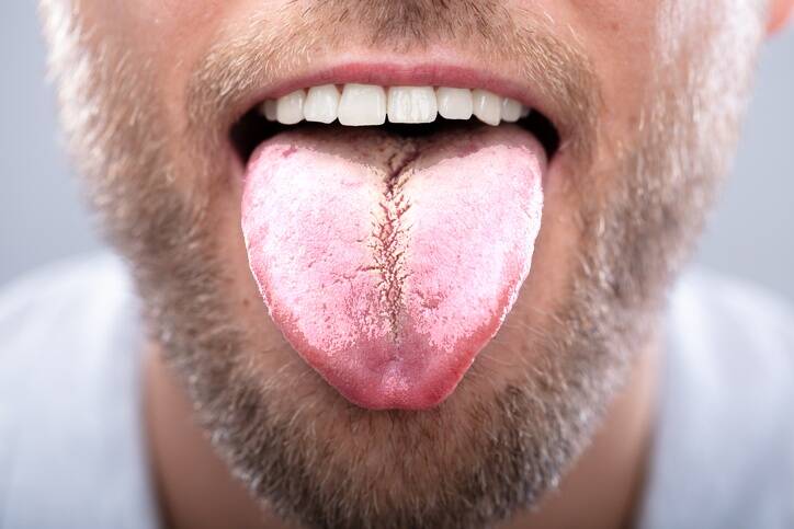 Weißer Zungenbelag: Was sind die Ursachen und wie kann man ihn beseitigen?