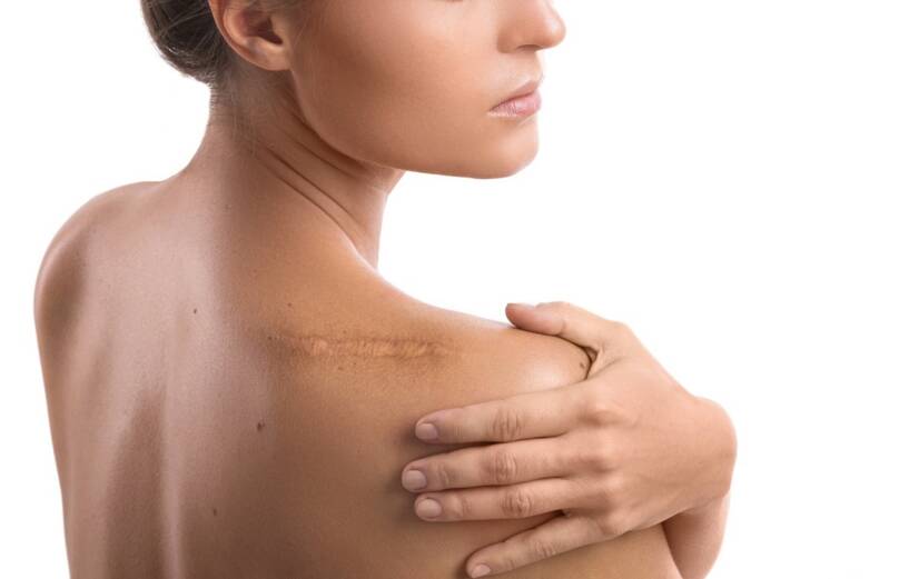 Narben auf der Haut: Wie entstehen sie + welche Behandlungsmöglichkeiten gibt es?