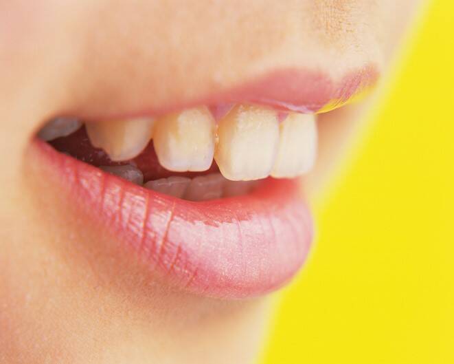Wackelnde Zähne: Was sind die Ursachen (bei Erwachsenen und Kindern)?