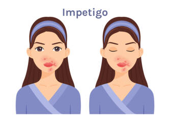 Was ist Impetigo, welche Symptome hat sie? Infektiosität und Übertragung bei Kindern