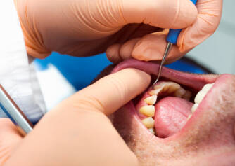 Parodontitis: Warum tritt sie auf? + Wie wird man eine Zahnlockerung los und die Zähne stärken?