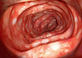 Colitis ulcerosa: Warum tritt sie auf, wie äußert sie sich? Was hilft der Behandlung?