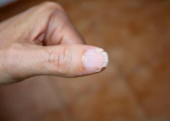 Brüchige Nägel und ihre Hauptursachen - wie kann man sie bekämpfen?
