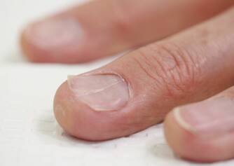 Eingewachsene Nägel: Warum entstehen sie? Diagnose und Behandlung