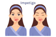 Was ist Impetigo, welche Symptome hat sie? Infektiosität und Übertragung bei Kindern