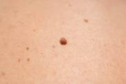 Was ist ein Fibrom auf der Haut, wie sieht es aus, welche Symptome hat es?