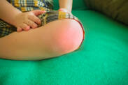 Juvenile idiopathische Arthritis: Symptome von Rheuma, Arthritis bei Kindern?