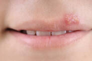 Herpes: Warum entsteht Lippenherpes und was hilft bei der Behandlung (wie wird man ihn los)?