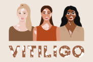 Vitiligo: Was ist Vitiligo und was sind die Ursachen und Symptome? Wann beginnt sie?