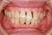 Zahnfleischbluten: Kennen Sie die häufigsten Ursachen?