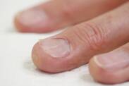 Eingewachsene Nägel: Warum entstehen sie? Diagnose und Behandlung