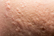 Pickel: Hautausschläge wie Pickel oder Nesselsucht und der Grund für ihr Auftreten?