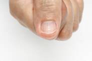Unästhetische Nagelfalten: Warum entstehen sie? Kann man sie verhindern?